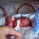 Preterm birth