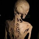 Fibrodysplasia ossificans progressiva