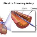 Stent