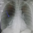 Chest trauma