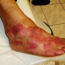 Inflammations