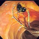 Digestive system procedures