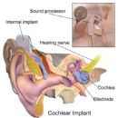 Cochlear implant