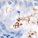 Helicobacter pylori