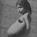 Precocious puberty and pregnancy
