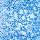 Small-blue-round-cell tumors
