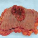 Neoplasm