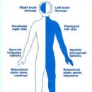 Hemiparesis