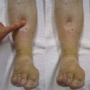 Lymphatic pathology