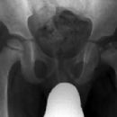Syndromes affecting bones