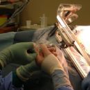 Biopsy