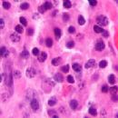 Multiple myeloma