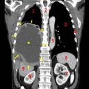 Oncology