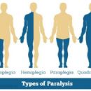 Paralysis