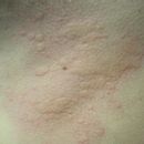 Respiratory diseases