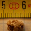 Kidney stone disease