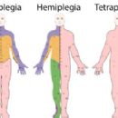 Tetraplegia