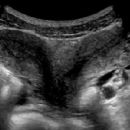 Congenital disorders of genital organs