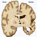 Geriatric psychiatry