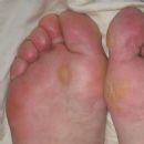 Foot diseases