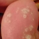 Cutaneous conditions