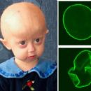 Cutaneous congenital anomalies