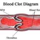 Ischemia
