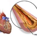 Heart diseases