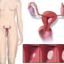 Endometrial cancer
