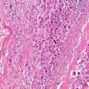 Osseous and chondromatous neoplasia