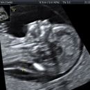 Pathology of pregnancy, childbirth and the puerperium