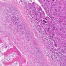 Causes of amputation