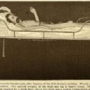 Paraplegia