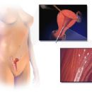Artificial insemination