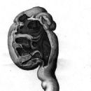 Nephritis