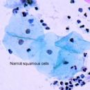 Dysplasia