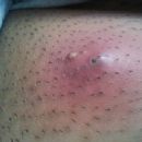 Cutaneous lesion